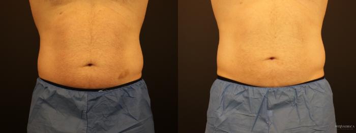 Before & After CoolSculpting Case 274 Front View in St. Louis, MO