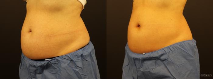 Before & After CoolSculpting Case 281 Left Oblique View in St. Louis, MO