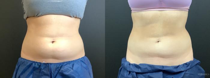 Before & After CoolSculpting Case 299 Front View in St. Louis, MO