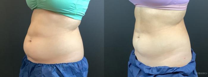 Before & After CoolSculpting Case 299 Left Oblique View in St. Louis, MO