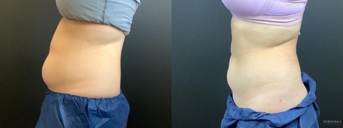 Before & After CoolSculpting Case 299 Left Side View in St. Louis, MO