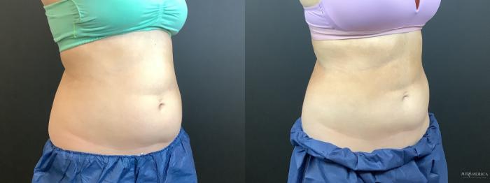 Before & After CoolSculpting Case 299 Right Oblique View in St. Louis, MO