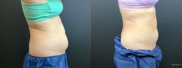 Before & After CoolSculpting Case 299 Right Side View in St. Louis, MO