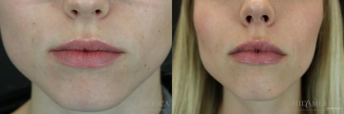 Before & After Dermal Fillers Case 153 View #1 View in Glen Carbon, IL