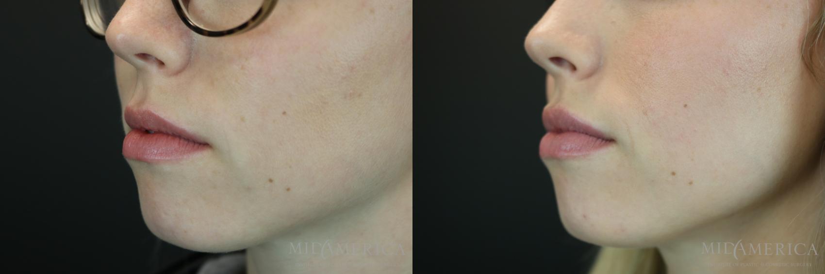 Dermal Fillers Before And After Pictures Case Glen Carbon IL MidAmerica Plastic Surgery