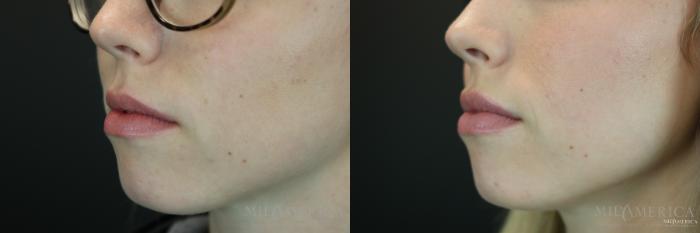 Before & After Dermal Fillers Case 153 View #2 View in St. Louis, MO