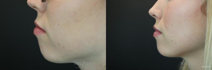 Before & After Dermal Fillers Case 153 View #3 View in St. Louis, MO