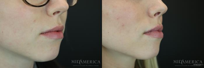 Before & After Dermal Fillers Case 153 View #4 View in St. Louis, MO