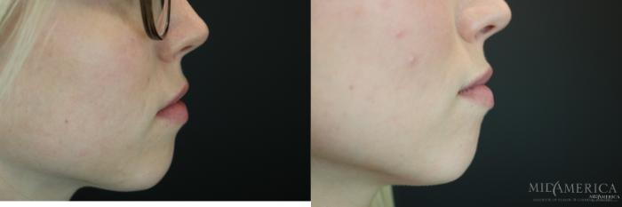 Before & After Dermal Fillers Case 153 View #5 View in St. Louis, MO