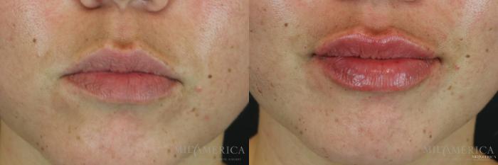 Before & After Dermal Fillers Case 159 View #1 View in St. Louis, MO