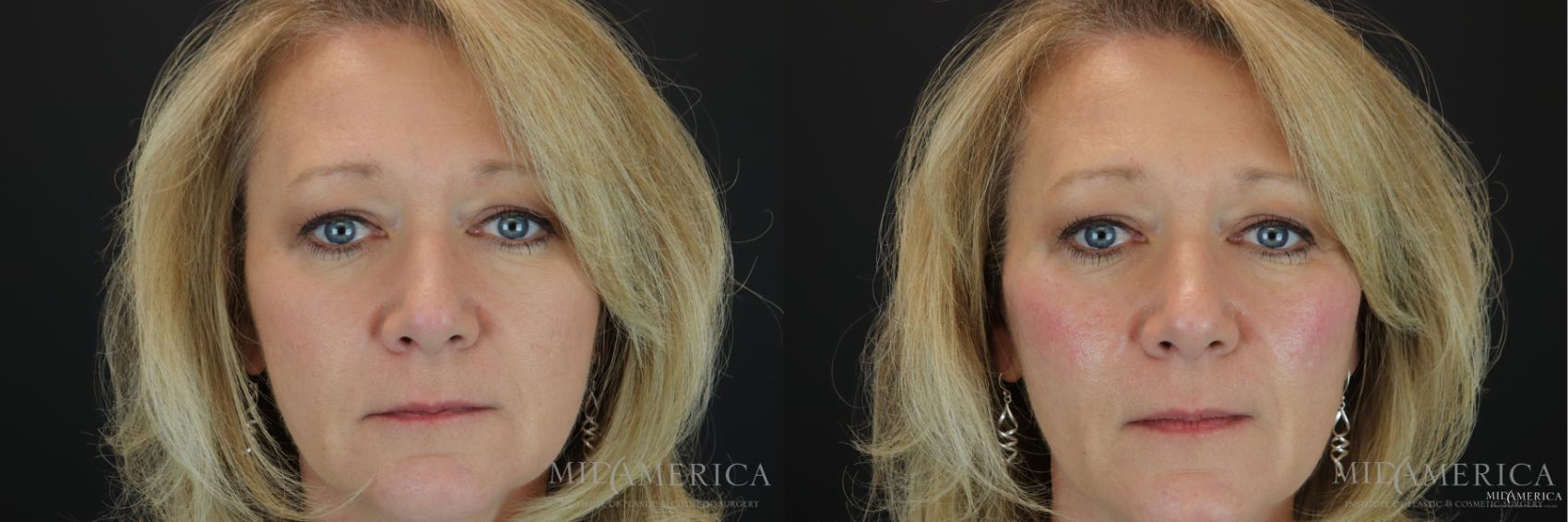 Before & After Dermal Fillers Case 163 View #1 View in Glen Carbon, IL