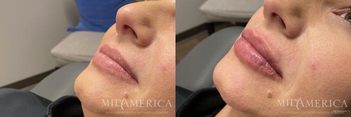 Before & After Dermal Fillers Case 164 View #1 View in Glen Carbon, IL