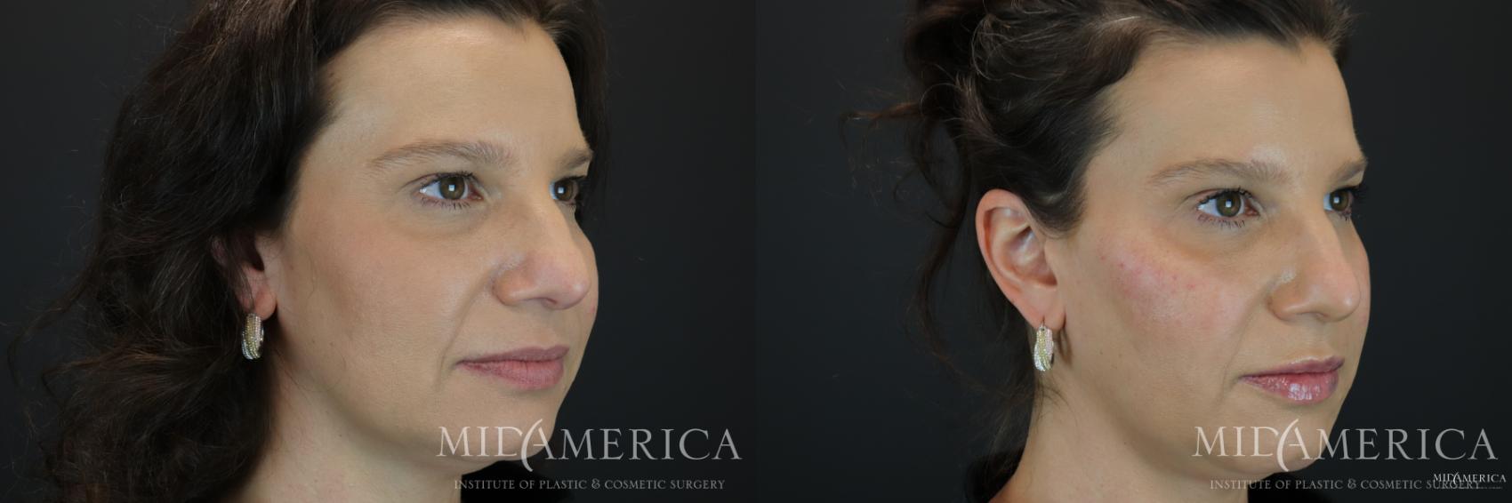 Before & After Dermal Fillers Case 165 View #1 View in St. Louis, MO