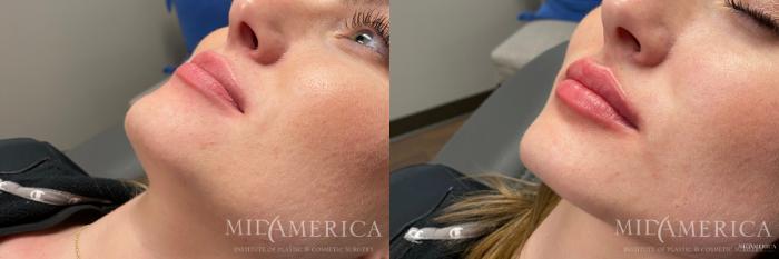 Before & After Dermal Fillers Case 166 View #1 View in Glen Carbon, IL