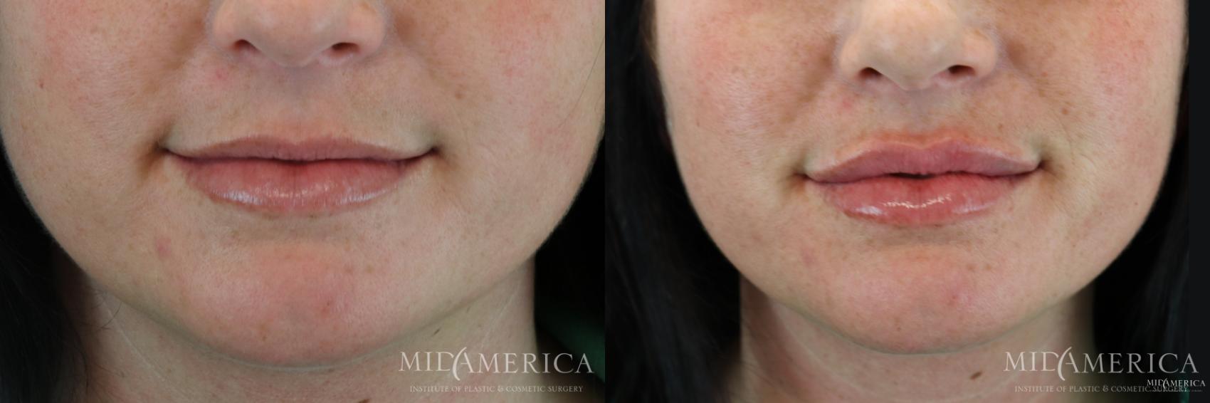Before & After Dermal Fillers Case 182 View #1 View in Glen Carbon, IL