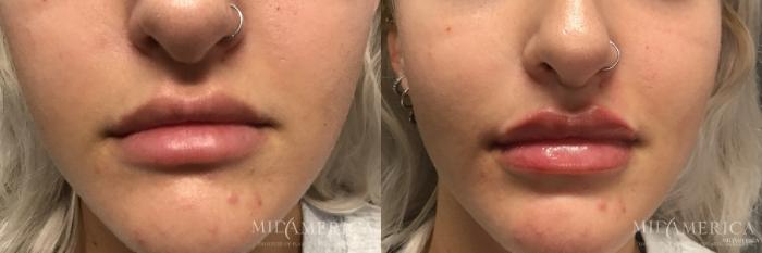Before & After Dermal Fillers Case 183 View #1 View in St. Louis, MO