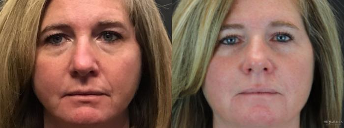 Before & After Dermal Fillers Case 184 Front View in St. Louis, MO