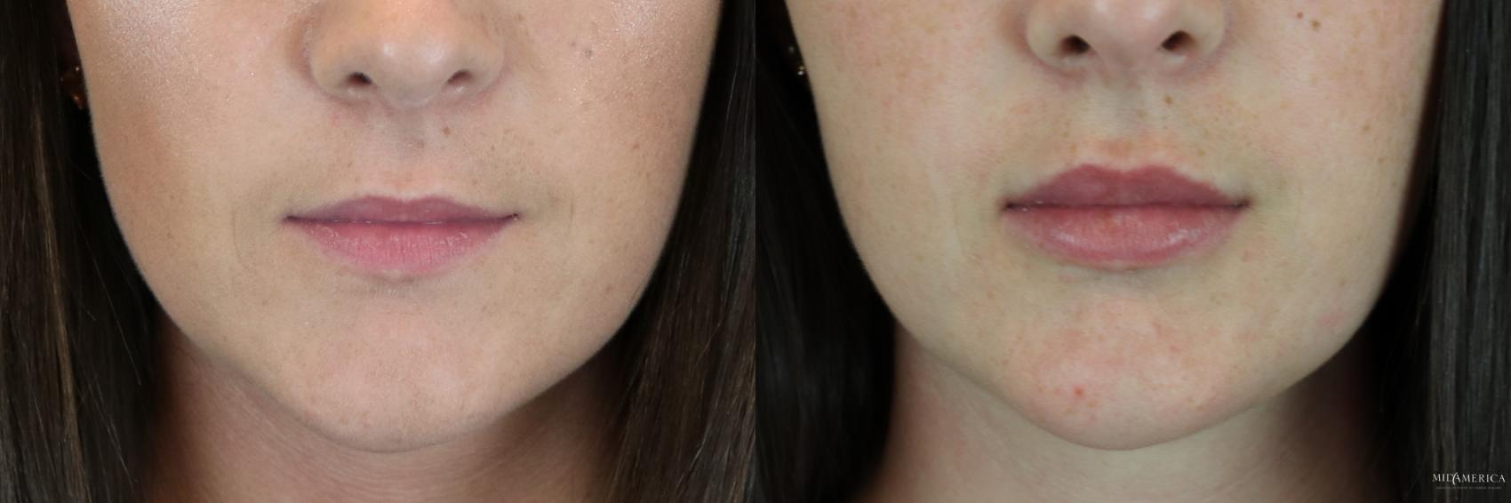Before & After Dermal Fillers Case 194 Front View in St. Louis, MO