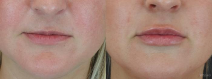 Before & After Dermal Fillers Case 272 Front View in Glen Carbon, IL