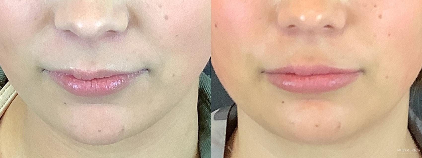 Before & After Dermal Fillers Case 295 Front View in St. Louis, MO