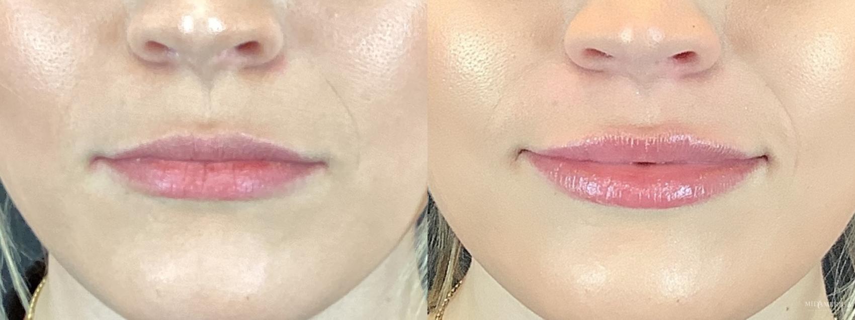 Before & After Dermal Fillers Case 296 Front View in St. Louis, MO