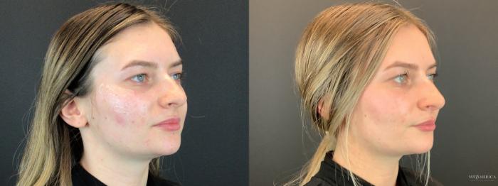 Before & After Dermal Fillers Case 297 Left Oblique View in St. Louis, MO