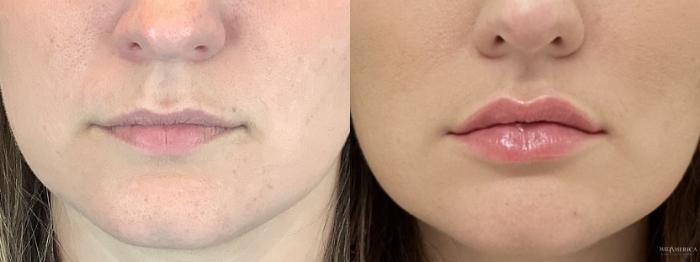Before & After Dermal Fillers Case 308 Front View in St. Louis, MO