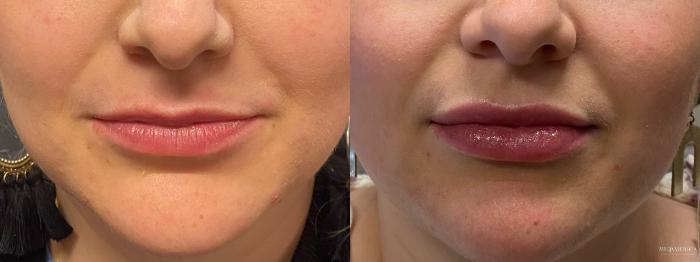 Before & After Dermal Fillers Case 311 Front View in St. Louis, MO