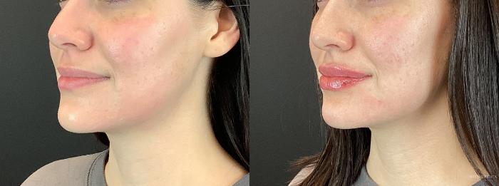 Before & After Dermal Fillers Case 328 Front View in St. Louis, MO