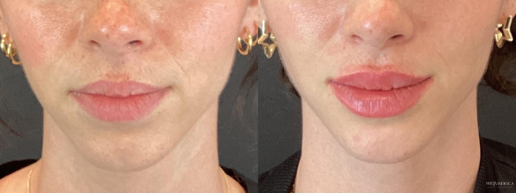 Before & After Dermal Fillers Case 355 Front View in Glen Carbon, IL