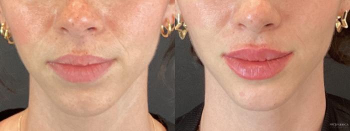 Before & After Dermal Fillers Case 355 Front View in St. Louis, MO