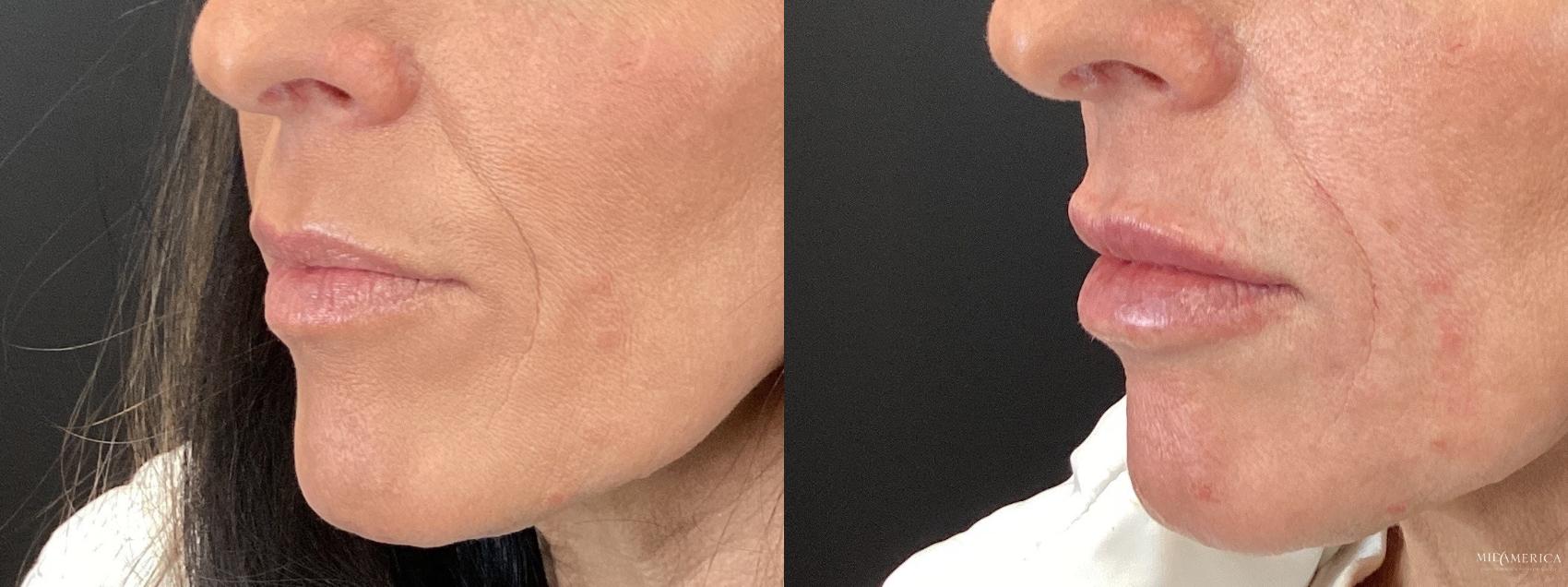 Before & After Dermal Fillers Case 381 Left Oblique View in St. Louis, MO