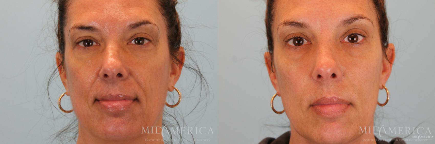 Before & After Dermal Fillers Case 44 View #1 View in Glen Carbon, IL