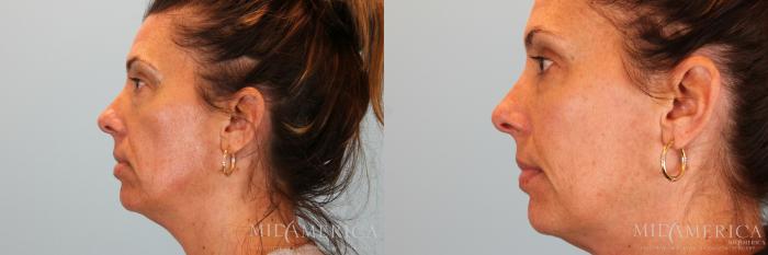 Before & After Dermal Fillers Case 44 View #2 View in St. Louis, MO