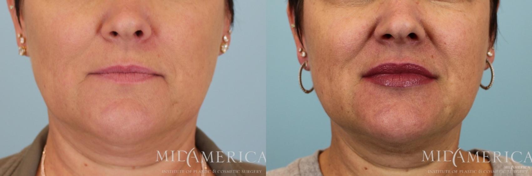 Before & After Dermal Fillers Case 60 View #1 View in St. Louis, MO