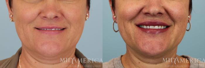 Before & After Dermal Fillers Case 60 View #2 View in St. Louis, MO