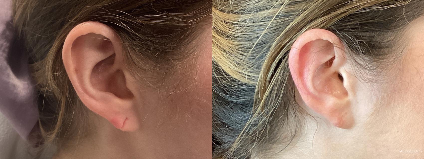 Before & After Ear Case 354 Left Side View in St. Louis, MO