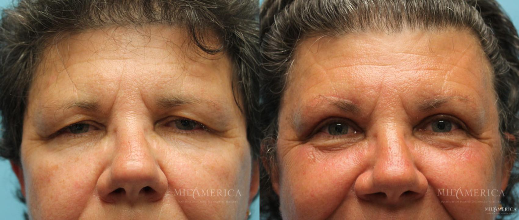 Before & After Eyelid Surgery Case 14 View #1 View in Glen Carbon, IL