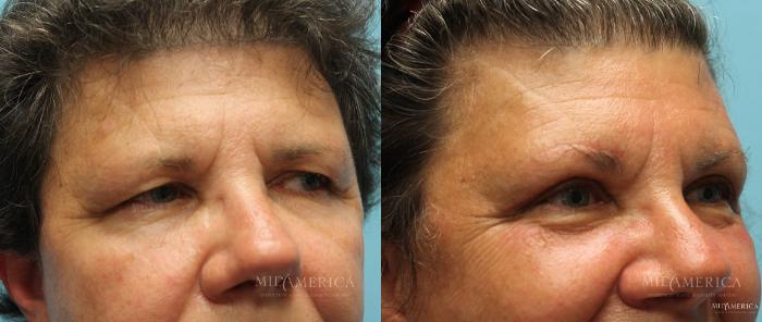 Before & After Eyelid Surgery Case 14 View #2 View in Glen Carbon, IL