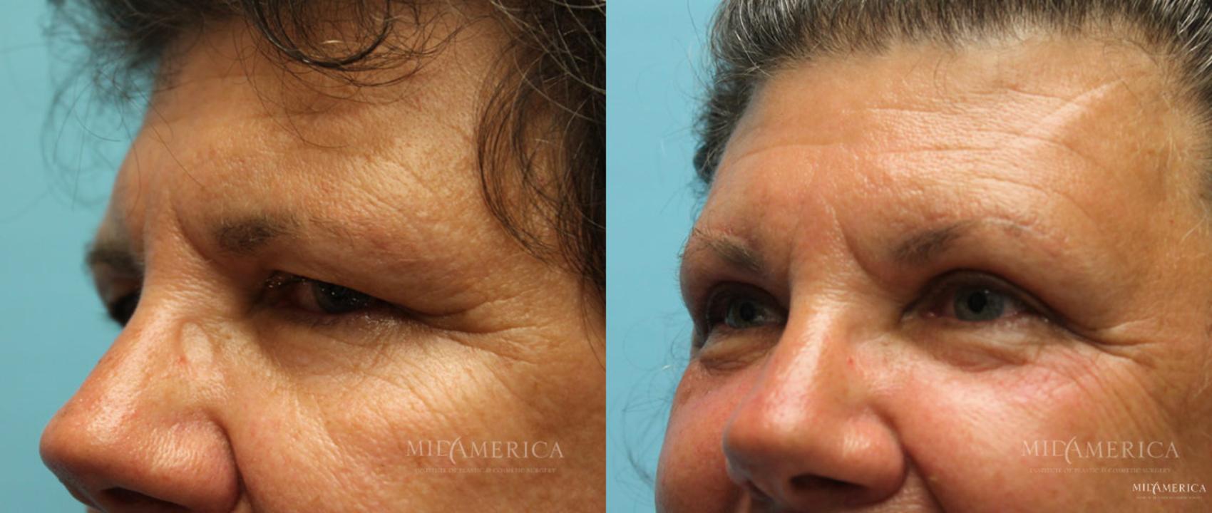 Before & After Eyelid Surgery Case 14 View #4 View in Glen Carbon, IL