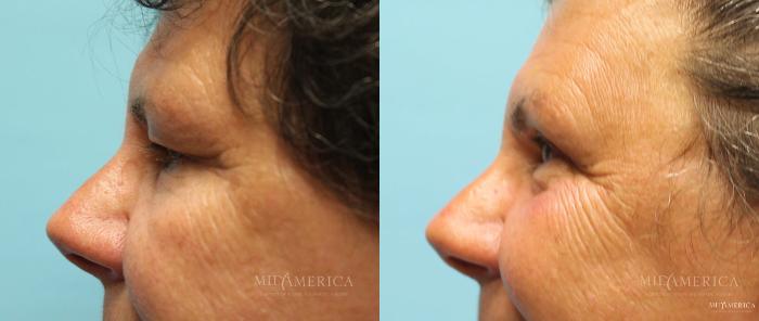 Before & After Eyelid Surgery Case 14 View #5 View in Glen Carbon, IL