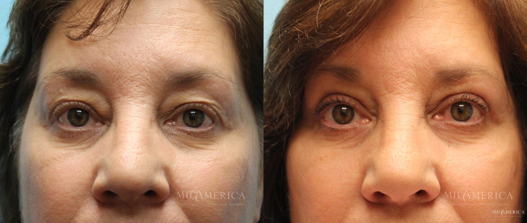 Before & After Eyelid Surgery Case 15 View #1 View in Glen Carbon, IL
