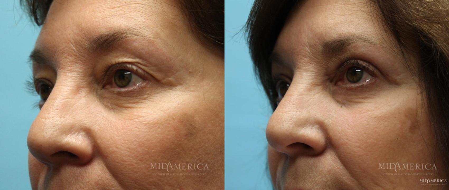 Before & After Eyelid Surgery Case 15 View #2 View in Glen Carbon, IL