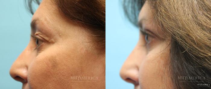Before & After Eyelid Surgery Case 15 View #3 View in Glen Carbon, IL