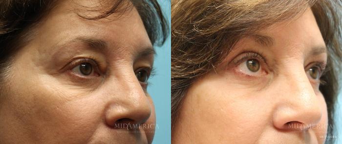 Before & After Eyelid Surgery Case 15 View #4 View in Glen Carbon, IL