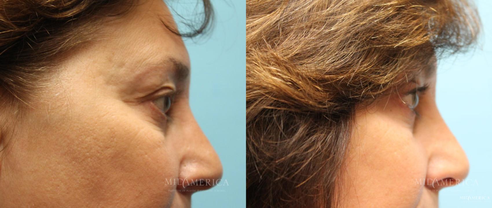 Before & After Eyelid Surgery Case 15 View #5 View in Glen Carbon, IL