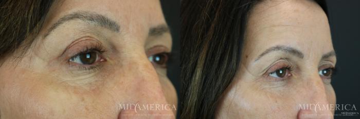 Before & After Eyelid Surgery Case 177 View #3 View in Glen Carbon, IL