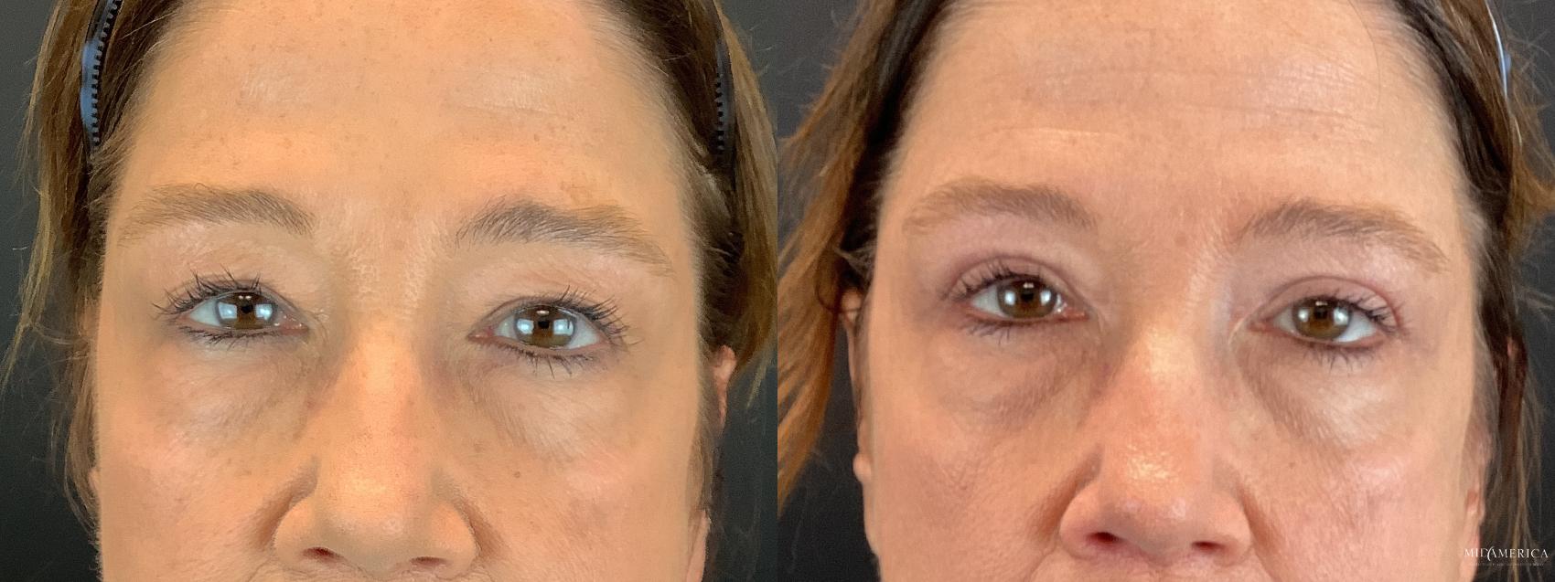 Before & After Eyelid Surgery Case 306 Front View in Glen Carbon, IL