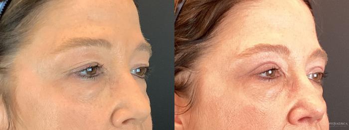 Before & After Eyelid Surgery Case 306 Right Side View in Glen Carbon, IL