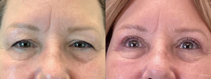 Before & After Eyelid Surgery Case 351 Front View in St. Louis, MO